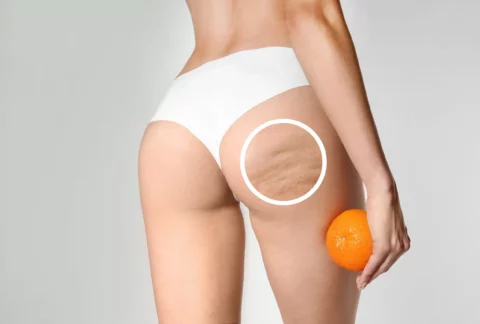 Cellulit - fizjoterapia w walce z problemem
