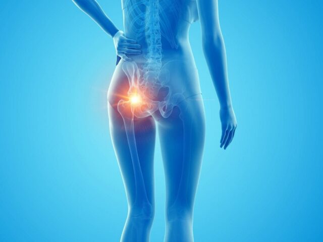 Zespół mięśnia gruszkowatego - objawy, przyczyny i rehabilitacja