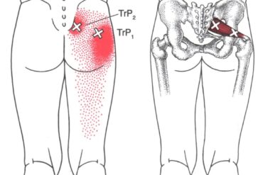 Shin splints, czyli ból piszczeli u biegaczy